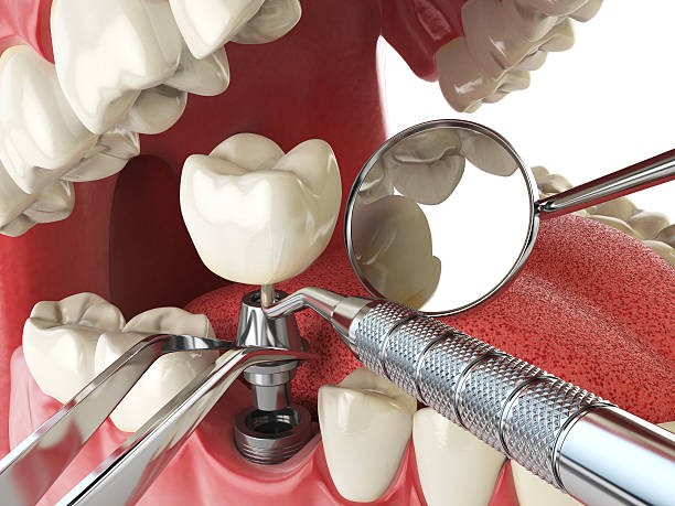 Best Urgent Care for Lost Fillings or Crowns in Soh Willard, UT